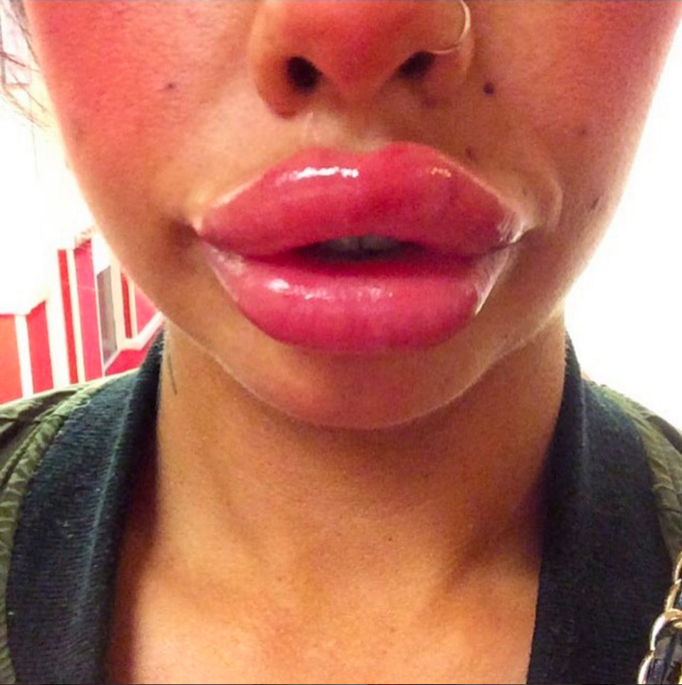 Alia Byrne, 30, from Liverpool who has had a massive amount of filler injected into her lips, August 2016. The single Mum-of-one splashes out on the beauty treatment to give herself the trout pout she's always dreamed of. In just under a year, the part-time care worker from Liverpool has had over 6.5ml of dermal fillers injected into her lips  splurging GBP250.00 per session (GBP1,625 in total) and now boasts the enormous smackers she always desired. Alia hopes to go even bigger with her lips and wants a further 1ml of fillers injected. Shes say the procedure is painful but worth it. Although some may feel that Alias cosmetically enhanced lips are excessive, Alia says that her new pout has made her happier than ever and she has even won thousands of admirers on social media. .. SEE COPY  PIC BY NEWS DOG MEDIA  +44 (0)121 517 0019
